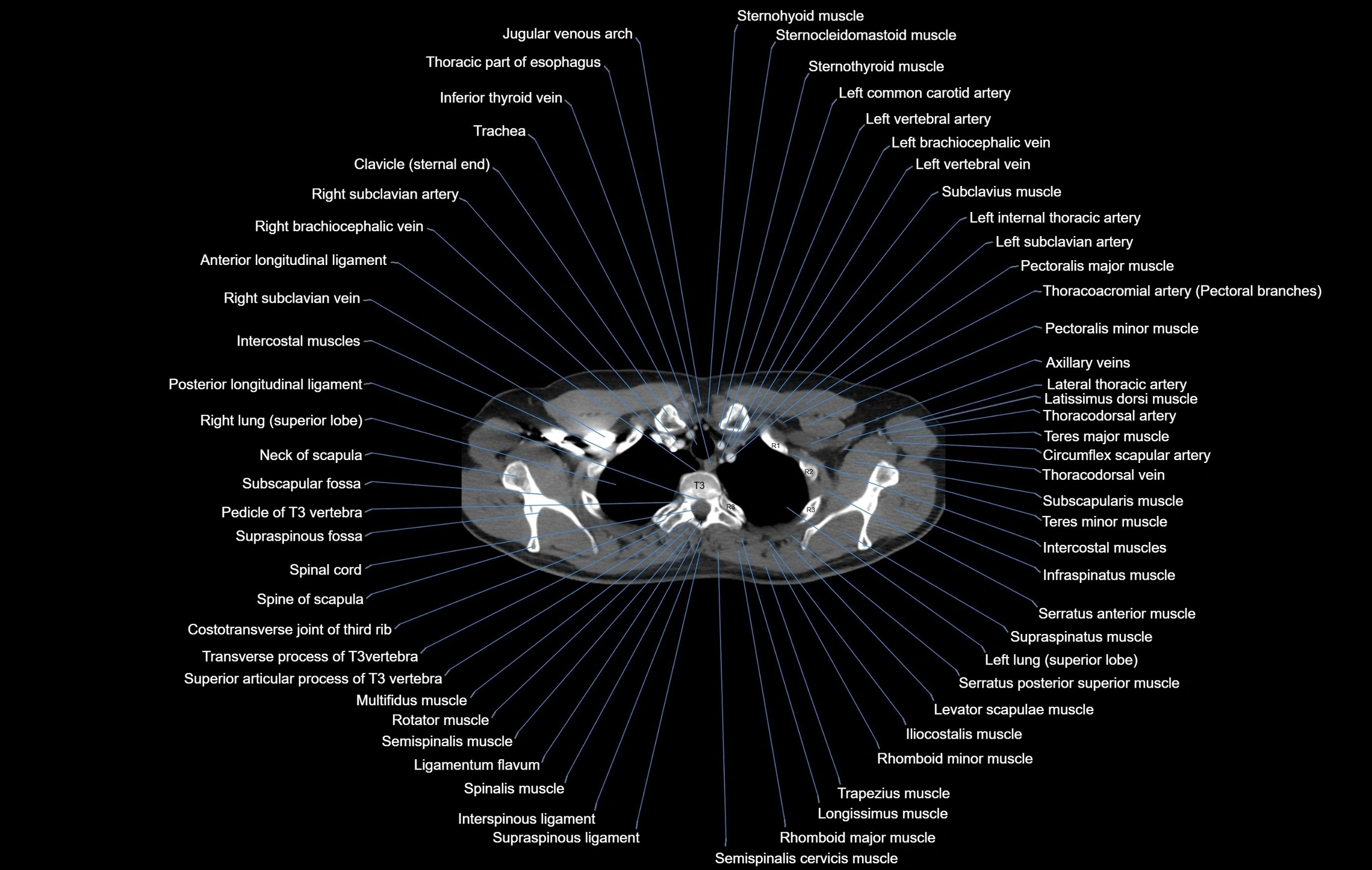 CT chest (thorax) labelled axial cross sectional anatomy radiology image-00016.webp